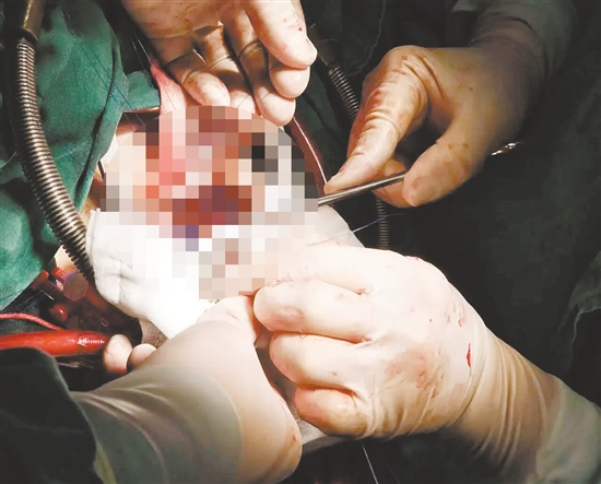 多學科協(xié)作完成手術(shù)。